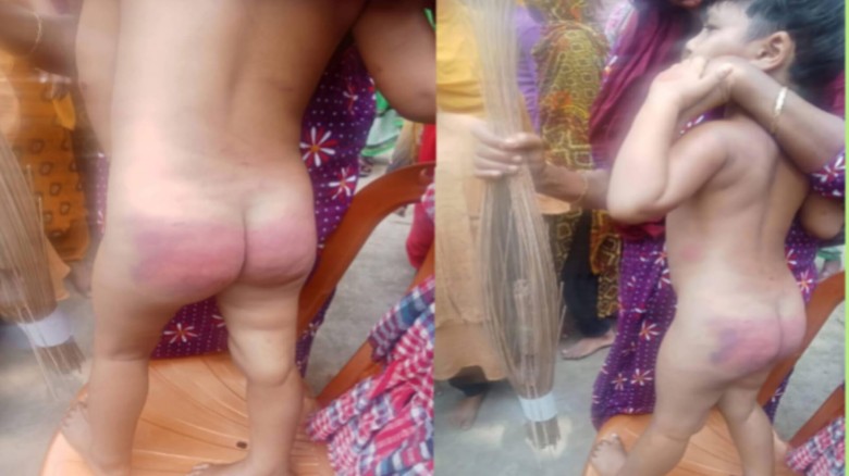 নির্বাক শিশু সোহা মনি; শরীরে সৎ মায়ের নির্মম নির্যাতনের চিহ্